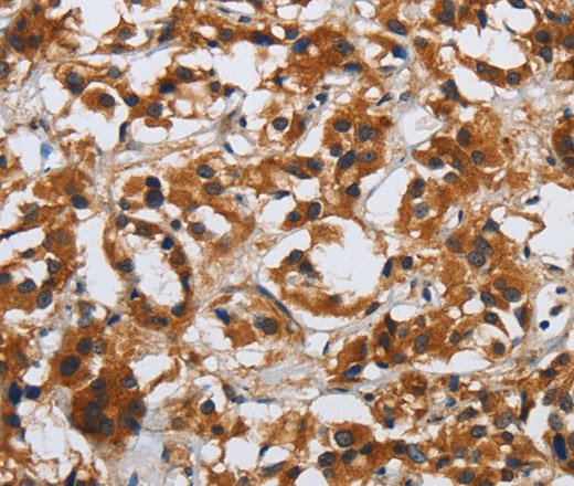 Immunohistochemistry of paraffin-embedded Human thyroid cancer tissue using DSP Polyclonal Antibody at dilution 1:40