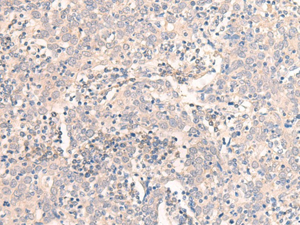 Immunohistochemistry of paraffin-embedded Human cervical cancer tissue  using EMX1 Polyclonal Antibody at dilution of 1:25(?200)