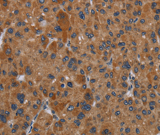 Immunohistochemistry of paraffin-embedded Human liver cancer tissue using OMG Polyclonal Antibody at dilution 1:30