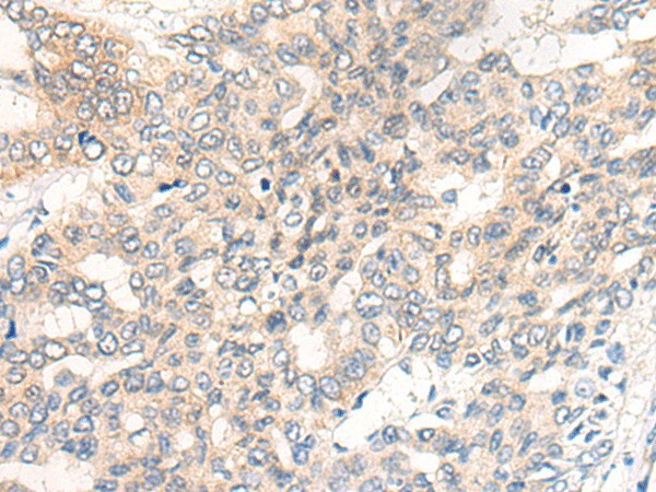 Immunohistochemistry of paraffin-embedded Human liver cancer tissue  using CHRD Polyclonal Antibody at dilution of 1:40(?200)