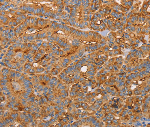 Immunohistochemistry of paraffin-embedded Human thyroid cancer using CD59 Polyclonal Antibody at dilution of 1:50