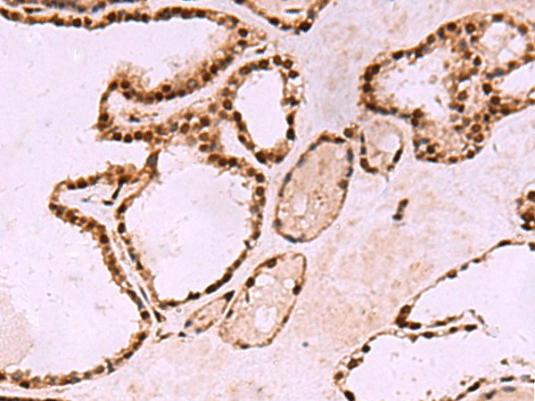 Immunohistochemistry of paraffin-embedded Human thyroid cancer tissue  using LDB1 Polyclonal Antibody at dilution of 1:70(?200)