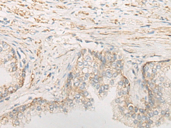 Immunohistochemistry of paraffin-embedded Human prost at e cancer tissue  using STOML2 Polyclonal Antibody at dilution of 1:25(?200)