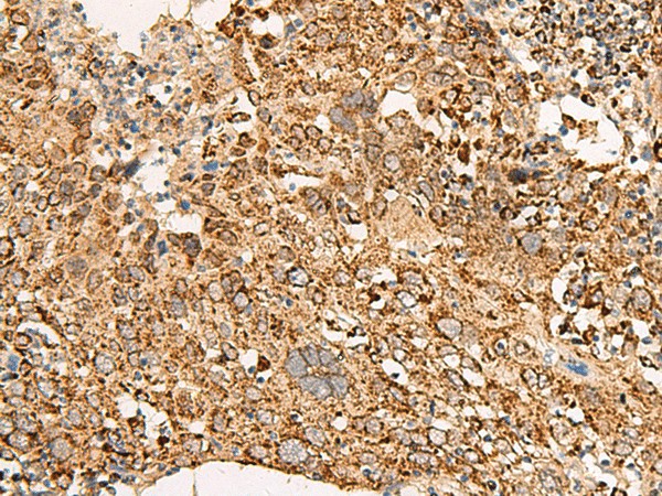 Immunohistochemistry of paraffin-embedded Human cervical cancer tissue  using ATP5I Polyclonal Antibody at dilution of 1:65(?200)