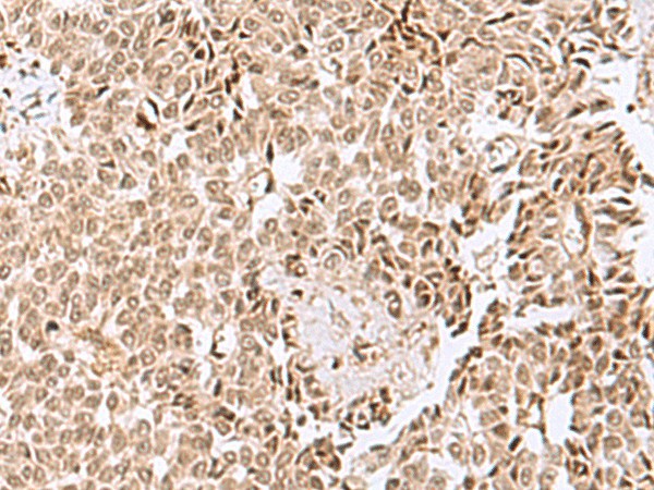 Immunohistochemistry of paraffin-embedded Human ovarian cancer tissue  using ELAC1 Polyclonal Antibody at dilution of 1:50(?200)