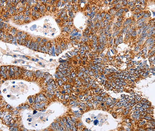 Immunohistochemistry of paraffin-embedded Human colon cancer tissue using MAP2K5 Polyclonal Antibody at dilution 1:40