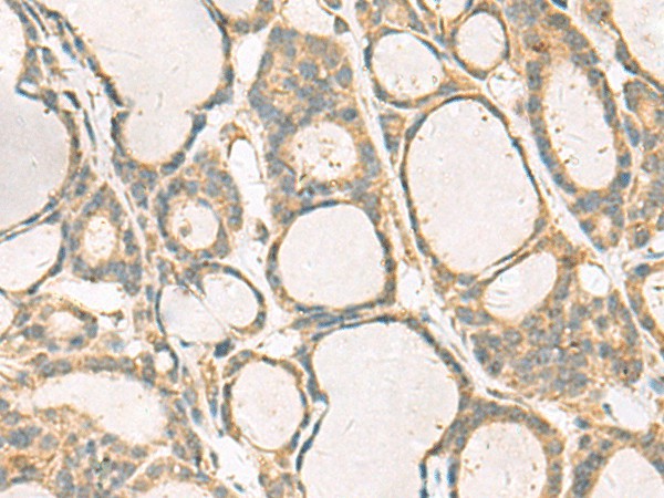 Immunohistochemistry of paraffin-embedded Human thyroid cancer tissue  using KIF2C Polyclonal Antibody at dilution of 1:70(?200)