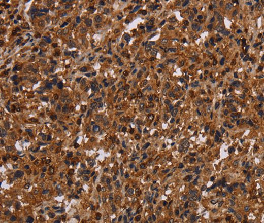 Immunohistochemistry of paraffin-embedded Human liver cancer tissue using MAGEC2 Polyclonal Antibody at dilution 1:40