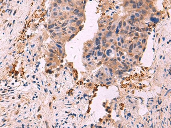 Immunohistochemistry of paraffin-embedded Human cervical cancer tissue  using SHC4 Polyclonal Antibody at dilution of 1:90(?200)