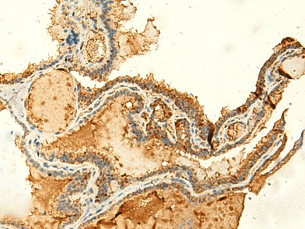 Immunohistochemistry of paraffin-embedded Human thyroid cancer tissue  using KIAA0513 Polyclonal Antibody at dilution of 1:50(?200)