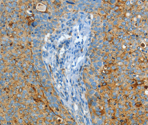 Immunohistochemistry of paraffin-embedded Human cervical cancer using ASAH1 Polyclonal Antibody at dilution of 1:50