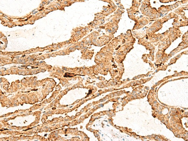 Immunohistochemistry of paraffin-embedded Human thyroid cancer tissue  using HBG1:HBG2 Polyclonal Antibody at dilution of 1:70(?200)