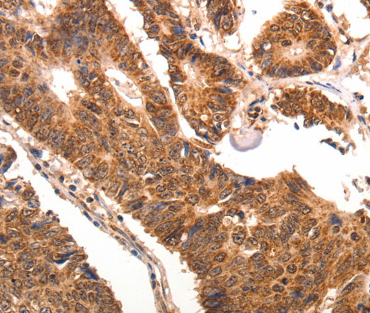 Immunohistochemistry of paraffin-embedded Human colon cancer using CCL17 Polyclonal Antibody at dilution of 1:70