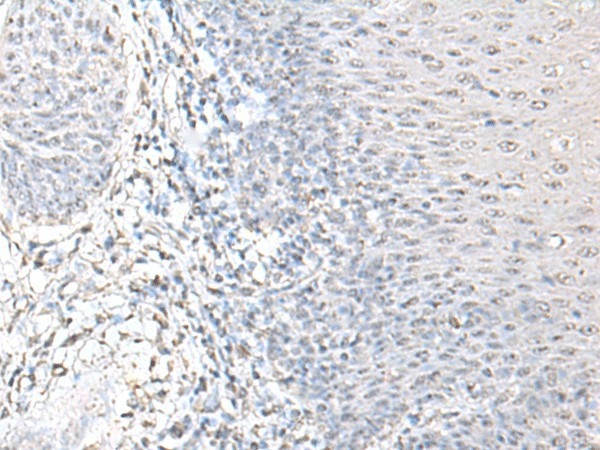 Immunohistochemistry of paraffin-embedded Human esophagus cancer tissue  using EPM2A Polyclonal Antibody at dilution of 1:55(?200)