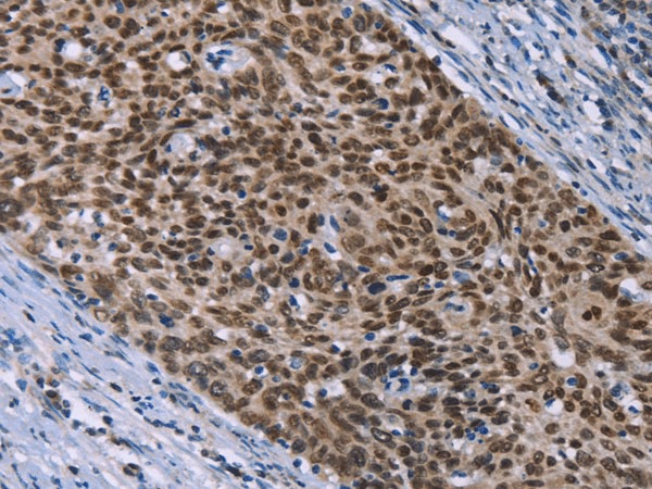 Immunohistochemistry of paraffin-embedded Human cervical cancer tissue using HMGA1  Polyclonal Antibody at dilution 1:30