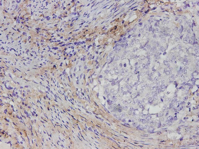 Immunohistochemistry of paraffin-embedded Human cervical cancer tissue using COL1A1 Polyclonal Antibody at dilution of 1:1700(?400)