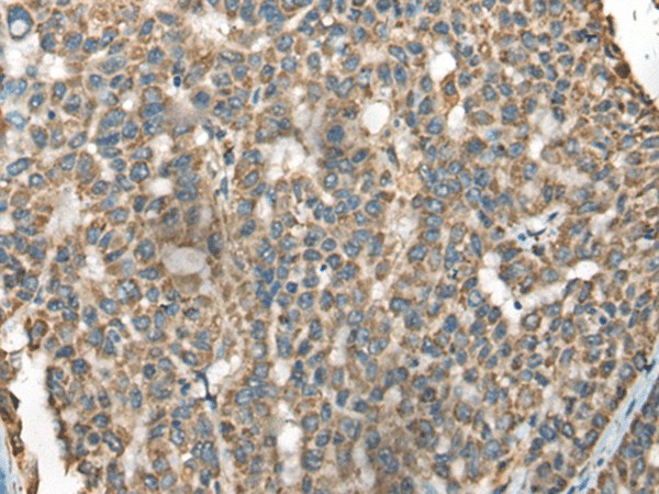 Immunohistochemistry of paraffin-embedded Human liver cancer tissue  using BLNK Polyclonal Antibody at dilution of 1:65(?200)