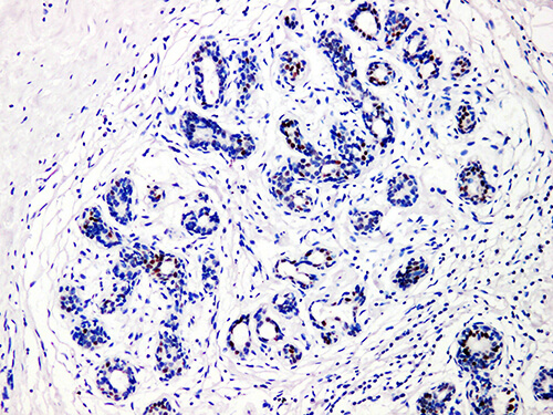 Immunohistochemistry of paraffinembedded Human Breast cancer with GATA3 Monoclonal Antibody(Antigen repaired by EDTA).