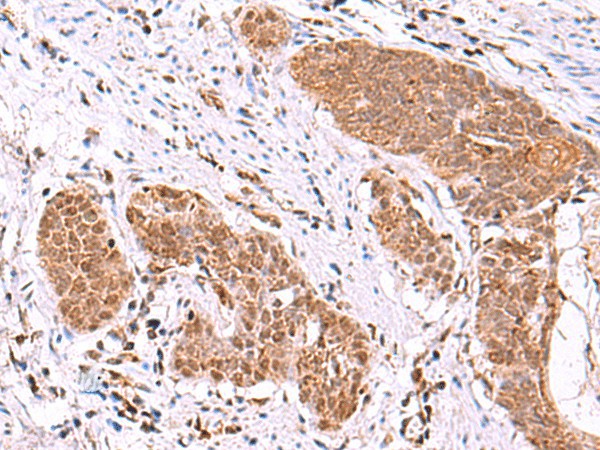 Immunohistochemistry of paraffin-embedded Human esophagus cancer tissue  using ASTN2 Polyclonal Antibody at dilution of 1:80(?200)