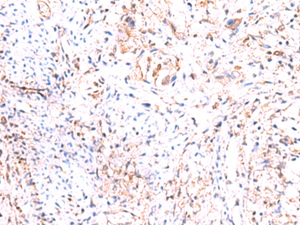 Immunohistochemistry of paraffin-embedded Human cervical cancer tissue  using PHKG2 Polyclonal Antibody at dilution of 1:60(?200)