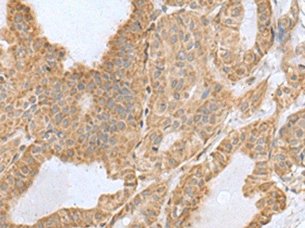 Immunohistochemistry of paraffin-embedded Human thyroid cancer tissue  using CSRP2 Polyclonal Antibody at dilution of 1:60(?200)