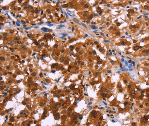 Immunohistochemistry of paraffin-embedded Human thyroid cancer tissue using USP2 Polyclonal Antibody at dilution 1:40