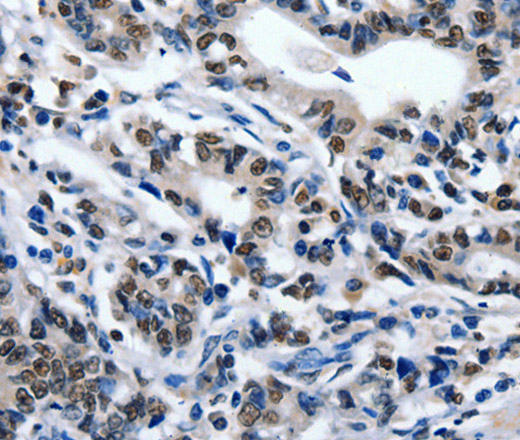 Immunohistochemistry of paraffin-embedded Human gasrtic cancer tissue using CD203c Polyclonal Antibody at dilution 1:80