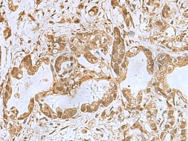 Immunohistochemistry of paraffin-embedded Human gastric cancer tissue  using PHF6 Polyclonal Antibody at dilution of 1:85(?200)