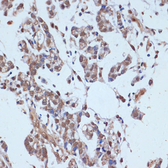 Immunohistochemistry of paraffin-embedded human gastric cancer using TP53BP2 Polyclonal Antibody at dilution of 1:100 (40x lens).Perform microwave antigen retrieval with 10 mM PBS buffer pH 7.2 before commencing with IHC staining protocol.