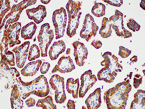 Immunohistochemistry of paraffinembedded Human thyroid tissue with Thyroglobulin(TG) Monoclonal Antibody(Antigen repaired by EDTA).