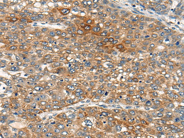 Immunohistochemistry of paraffin-embedded Human liver cancer tissue  using B4GAT1 Polyclonal Antibody at dilution of 1:110(?200)