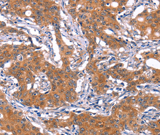 Immunohistochemistry of paraffin-embedded Human gasrtic cancer tissue using IRS1 Polyclonal Antibody at dilution 1:30