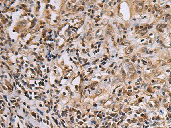 Immunohistochemistry of paraffin-embedded Human esophagus cancer tissue  using DNA2 Polyclonal Antibody at dilution of 1:60(?200)