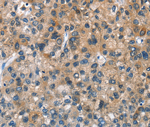 Immunohistochemistry of paraffin-embedded Human liver cancer tissue using BPI Polyclonal Antibody at dilution 1:50