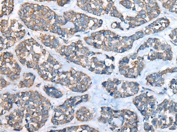 Immunohistochemistry of paraffin-embedded Human esophagus cancer tissue  using GULP1 Polyclonal Antibody at dilution of 1:65(?200)