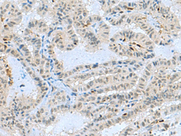 Immunohistochemistry of paraffin-embedded Human thyroid cancer tissue  using TCF19 Polyclonal Antibody at dilution of 1:60(?200)