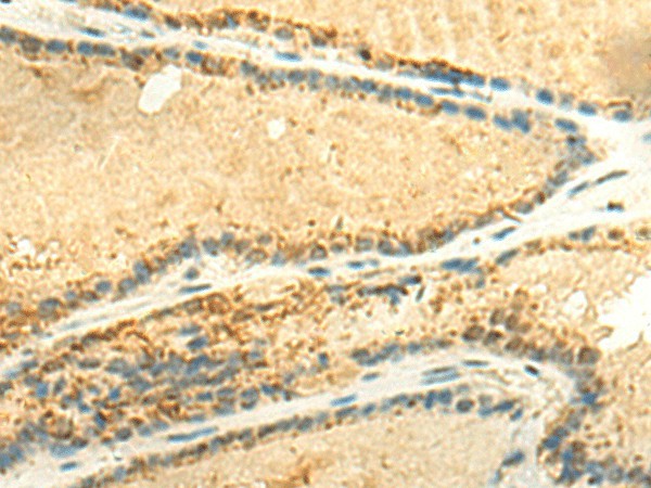 Immunohistochemistry of paraffin-embedded Human thyroid cancer tissue  using EEF1AKMT2 Polyclonal Antibody at dilution of 1:50(?200)