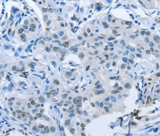 Immunohistochemistry of paraffin-embedded Human lung cancer tissue using ARHGEF2 Polyclonal Antibody at dilution 1:30