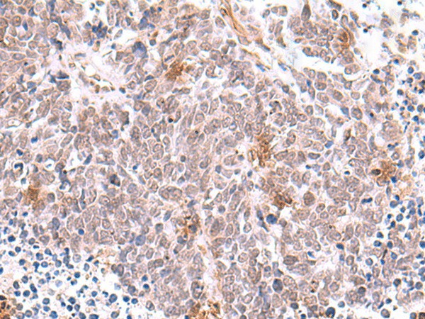 Immunohistochemistry of paraffin-embedded Human lung cancer tissue  using INPP5K Polyclonal Antibody at dilution of 1:90(?200)