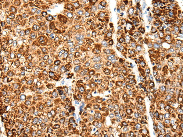 Immunohistochemistry of paraffin-embedded Human liver cancer tissue  using CACNG5 Polyclonal Antibody at dilution of 1:50(?200)