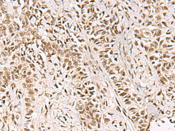 Immunohistochemistry of paraffin-embedded Human ovarian cancer tissue  using GABPB1 Polyclonal Antibody at dilution of 1:55(?200)