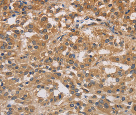 Immunohistochemistry of paraffin-embedded Human thyroid cancer tissue using DSTN Polyclonal Antibody at dilution 1:30