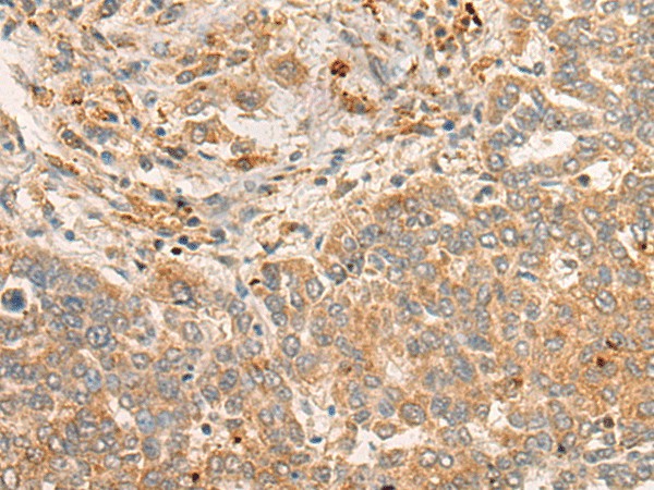 Immunohistochemistry of paraffin-embedded Human liver cancer tissue  using FBXO32 Polyclonal Antibody at dilution of 1:45(?200)