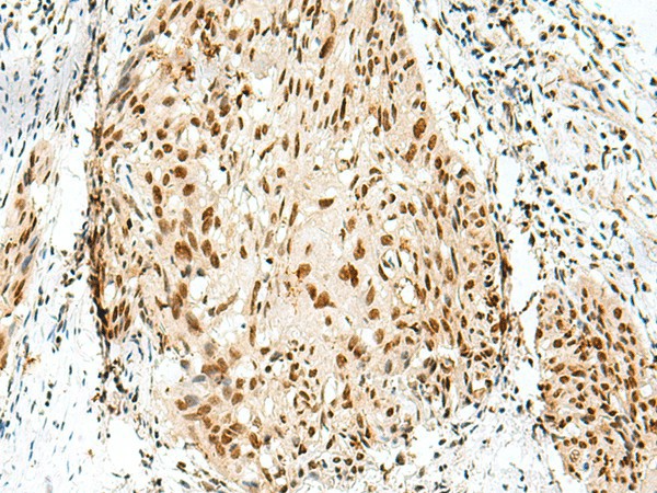 Immunohistochemistry of paraffin-embedded Human esophagus cancer tissue  using RBM10 Polyclonal Antibody at dilution of 1:55(?200)