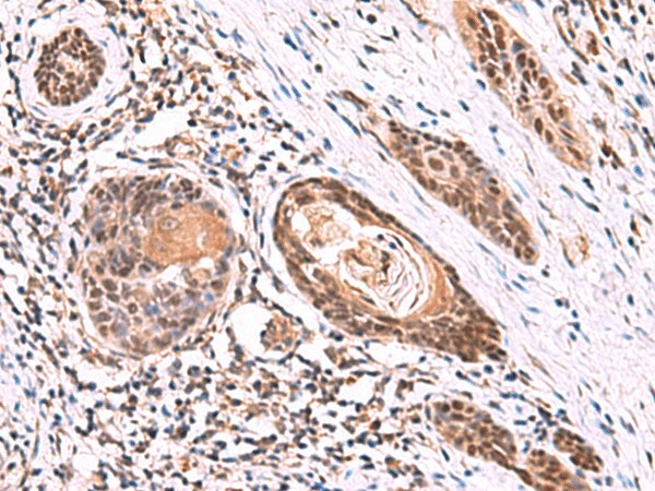 Immunohistochemistry of paraffin-embedded Human esophagus cancer tissue  using ITPR2 Polyclonal Antibody at dilution of 1:60(?200)