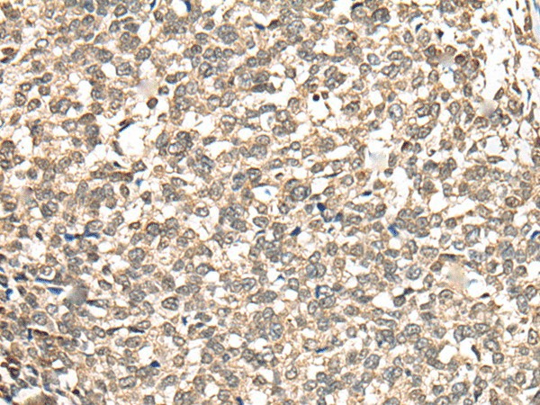 Immunohistochemistry of paraffin-embedded Human esophagus cancer tissue  using PHF21A Polyclonal Antibody at dilution of 1:50(?200)