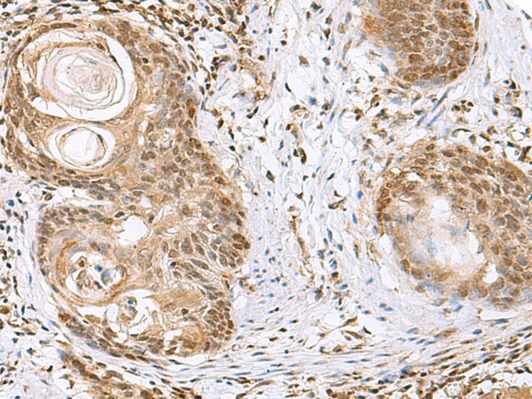 Immunohistochemistry of paraffin-embedded Human esophagus cancer tissue  using ELAC1 Polyclonal Antibody at dilution of 1:65(?200)