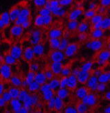 Immunofluorescence analysis of Human liver cancer tissue using Cleaved-CASP3 p12 (D175) Polyclonal Antibody at dilution of 1:200.