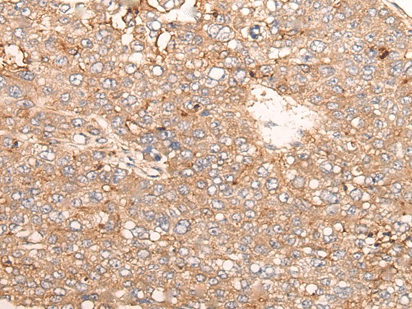 Immunohistochemistry of paraffin-embedded Human liver cancer tissue  using SIGLECL1 Polyclonal Antibody at dilution of 1:65(?200)