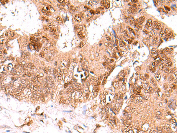 Immunohistochemistry of paraffin-embedded Human colorectal cancer tissue  using FDPS Polyclonal Antibody at dilution of 1:60(?200)